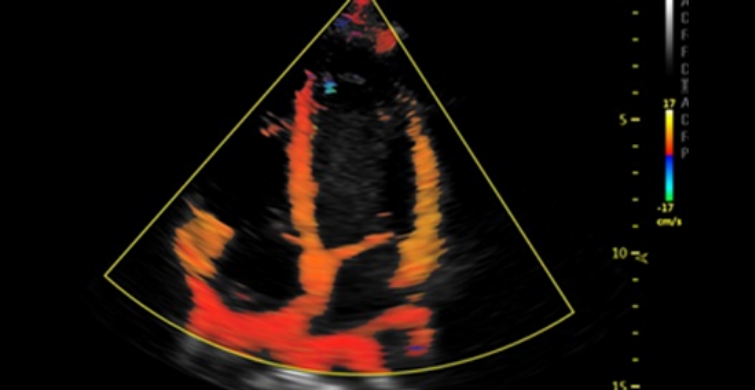 TVI (Tissue Velocity Imaging)_TVI